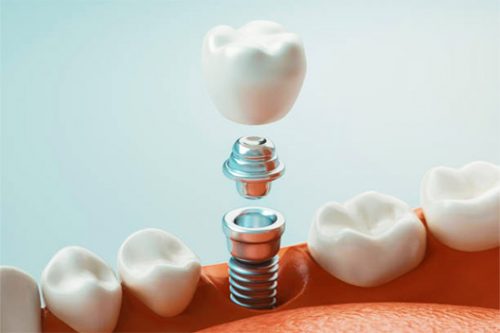 Dental implant surgery in Fort Lauderdale
