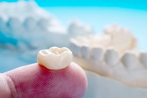 Dental crowns and bridges in Fort Lauderdale
